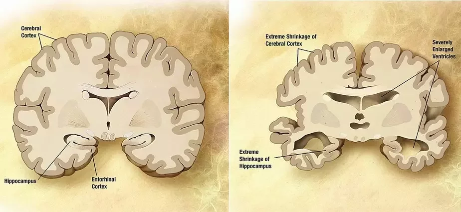 Мозг пожилого человека в норме (слева) и при патологии, вызванной болезнью Альцгеймера (справа). Фото из Википедии.